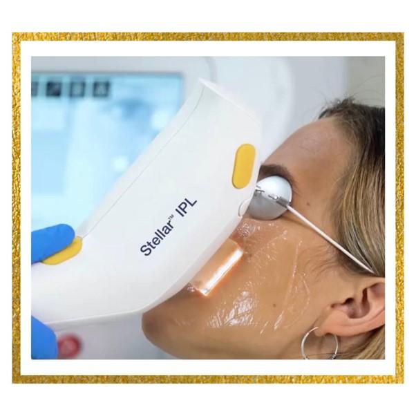 Face treatment with laser