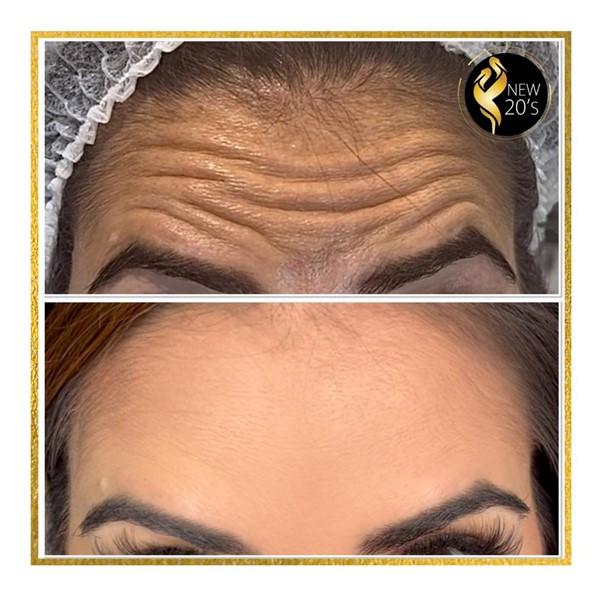 Before and after botox treatment