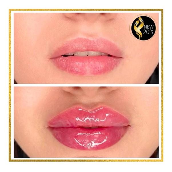 Before and after (lips)